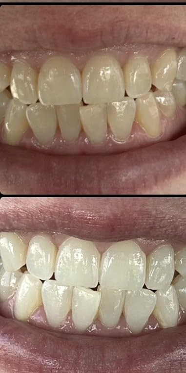 Crest Teeth Whitening Strips, Crest 3D Whitestrips Professional Effects, Enamel Safe Teeth Whitening Kit, 22 Treatments (44 Strips), Professional-Level Whitening, 19 Levels Whiter customer photo 1