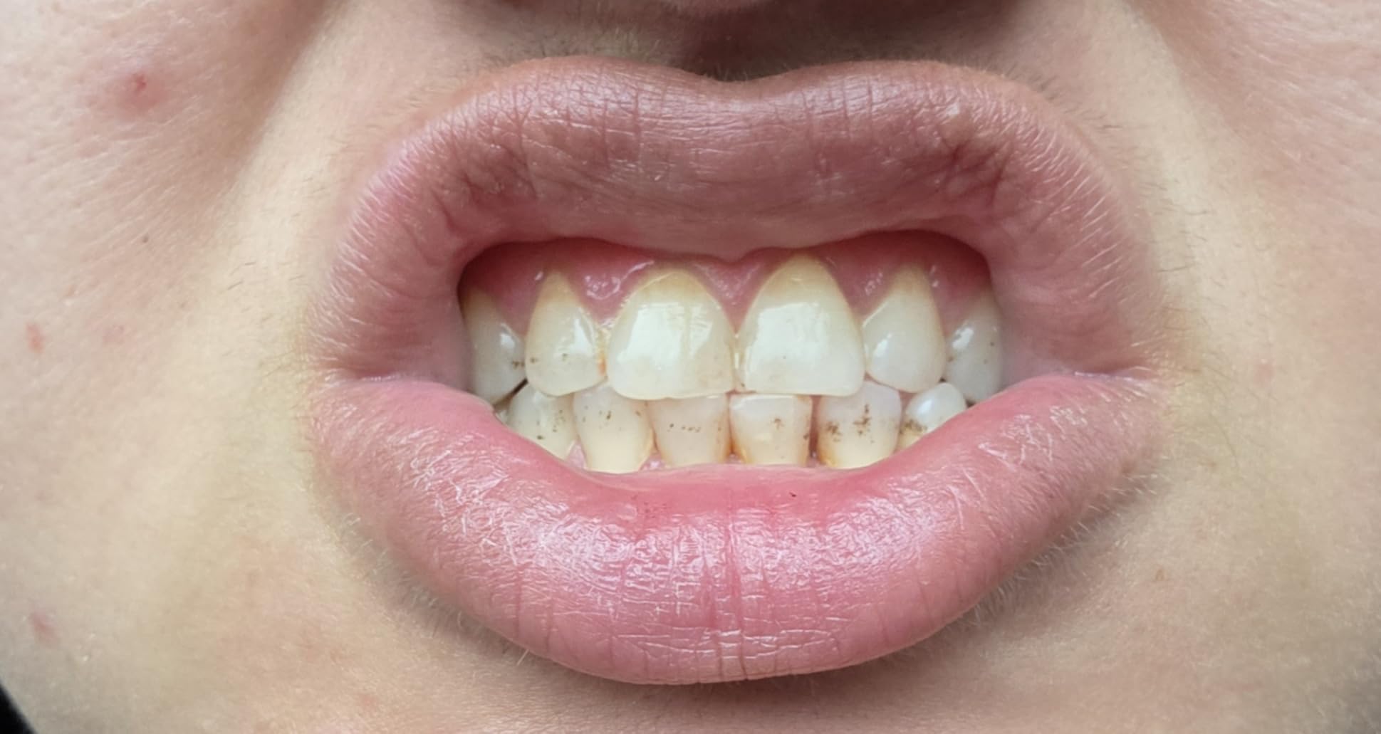 Auraglow Teeth Whitening Kit, LED Accelerator Light, 35% Carbamide Peroxide Teeth Whitening Gel, 20+ Whitening Treatments, Whitens up to 10 Shades in 7 Days customer photo 2