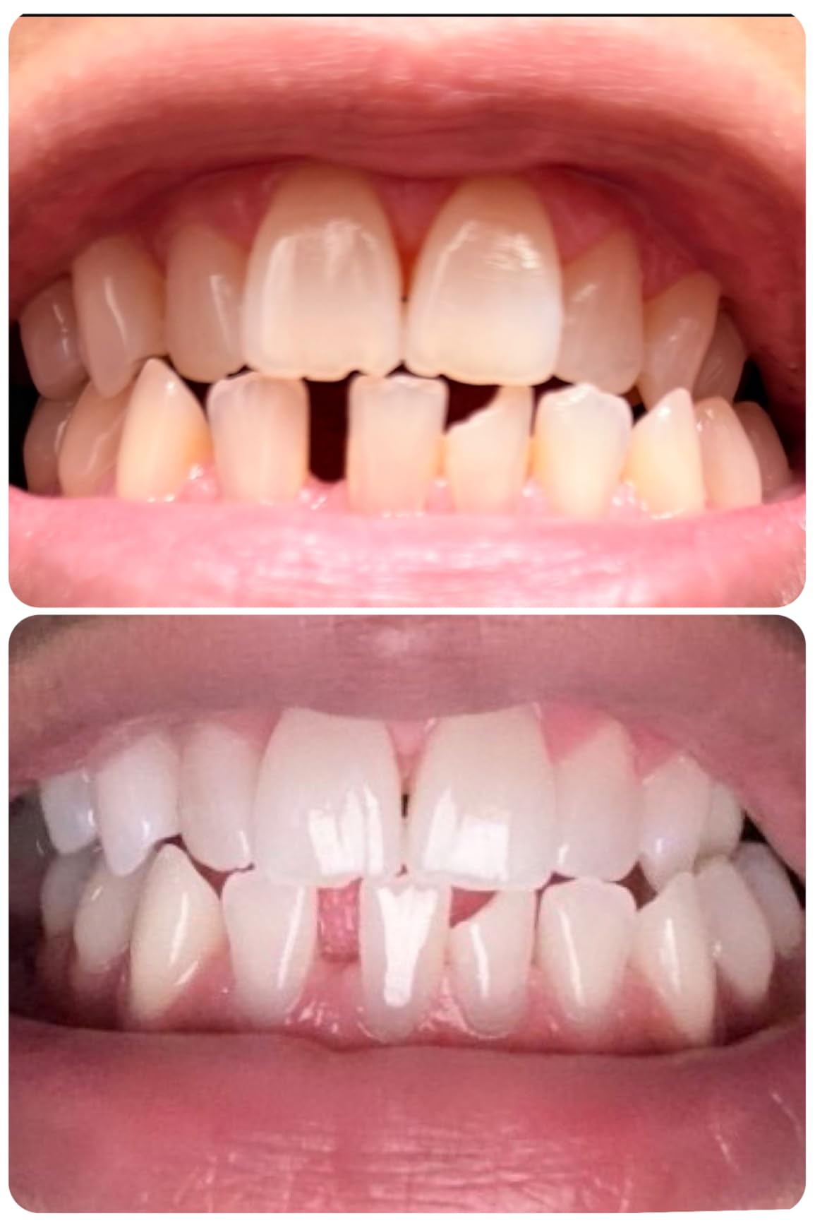 Crest Teeth Whitening Strips, Crest 3D Whitestrips Vivid Plus, Enamel Safe Teeth Whitening Kit, 12 Treatments (24 Strips), Visibly Whitens in Days, 8 Levels Whiter customer photo 1